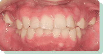 インビザラインフル治療前