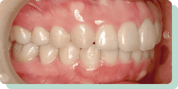 インビザラインフル治療後