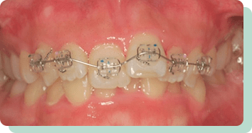 部分矯正（ワイヤー矯正）治療中